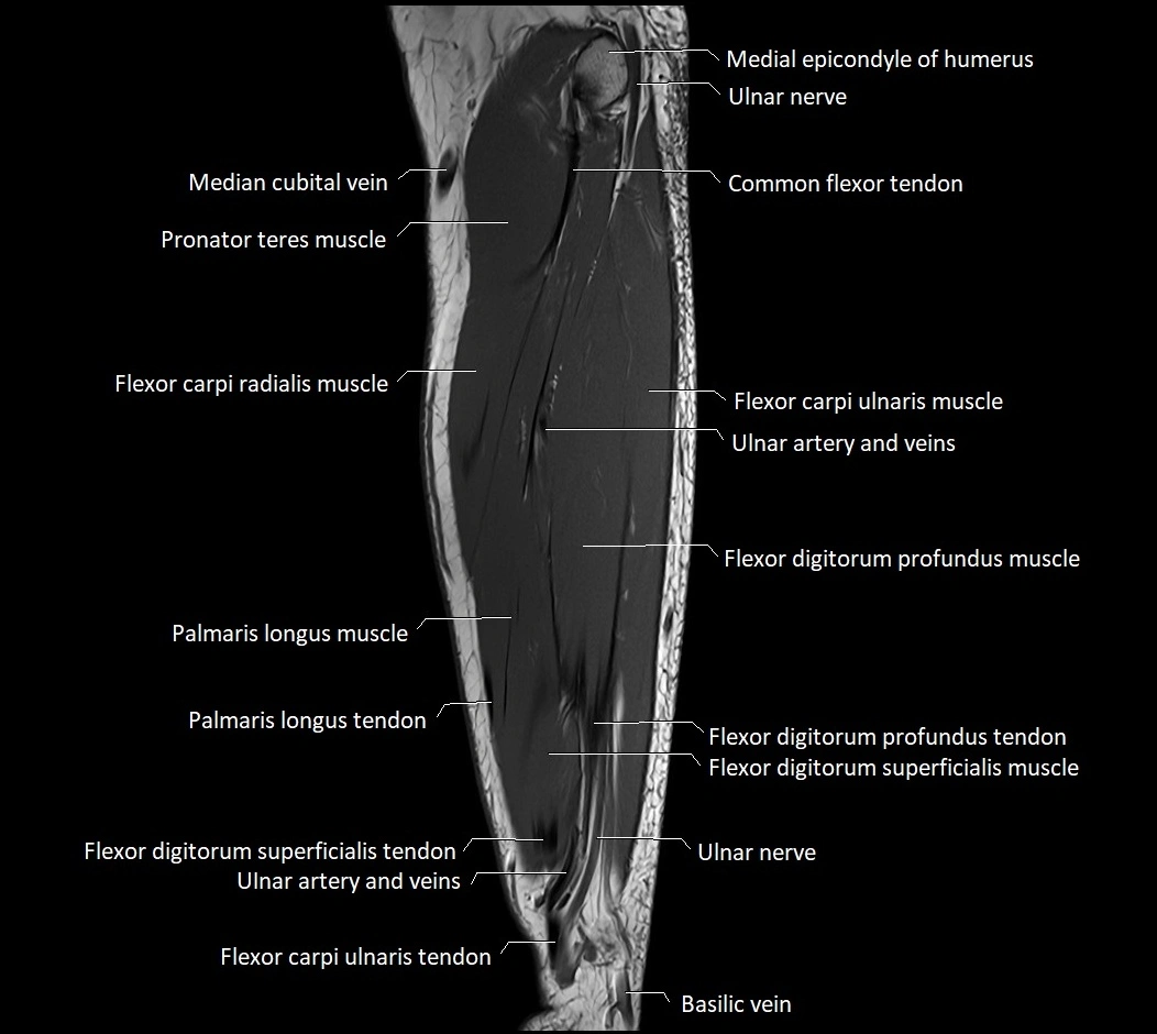 MRI 3T forearm sagittal labelled cross sectional anatomy image 30.webp
